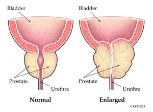 Holmium Laser Enucleation of the Prostate (HoLEP) in Abuja