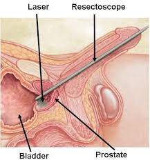Laser Prostate Procedure in Abuja