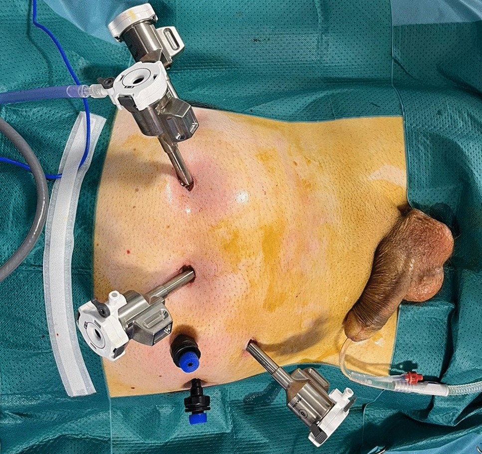 Where to Do Robotic Radical Prostatectomy in Abuja