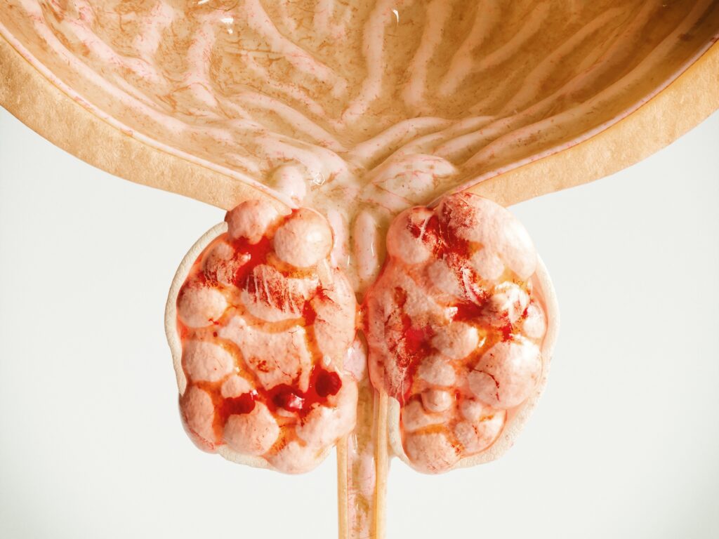 Where Can I Do Thulium Fiber Laser Enucleation of the Prostate (ThuFLEP) in Nigeria?